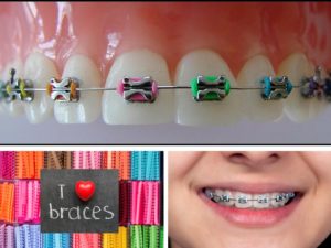A collage of photos illustrating how coloured elastics work and how they can personalize the wearing of braces