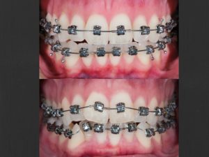 Milton_Orthodontics_Gallery_Brace_Before_After