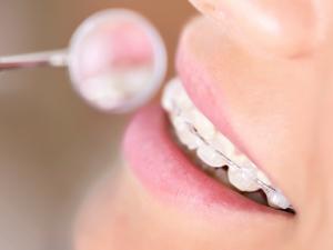 Milton Orthodontics Adult Ceramic Braces with a Dental Mirror, Examination