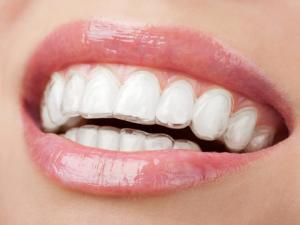 Milton Orthodontics Adult with Adult Invisalign Aligners with a Beautiful Smile