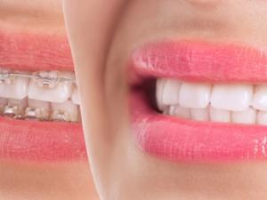 Milton Orthodontics Adult Treatment Before After                      
