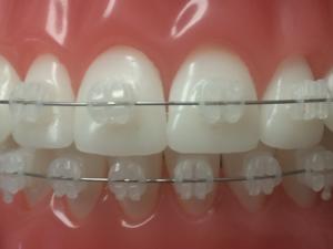 Milton Orthodontics Clear or Ceramic Braces