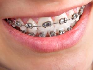 Milton Orthodontics Close Up of teen male wearing metal braces, smiling   