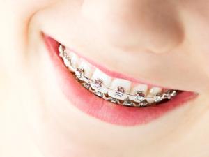 Milton Orthodontics Teen Boy smiling with white elastics on metal braces smiling