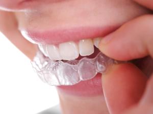 Milton Orthodontics Adult Woman Inserting Upper Invisalign Retainers