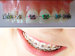 Milton Orthodontics, Two Images Illustrating Coloured Elastics on a Mold and on a Patient 